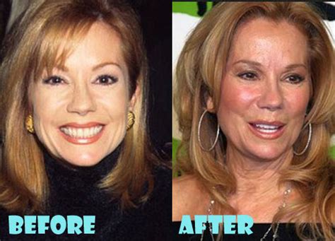 Kathie Lee Gifford Plastic Surgery Facelift, Facial Filler - Lovely ...