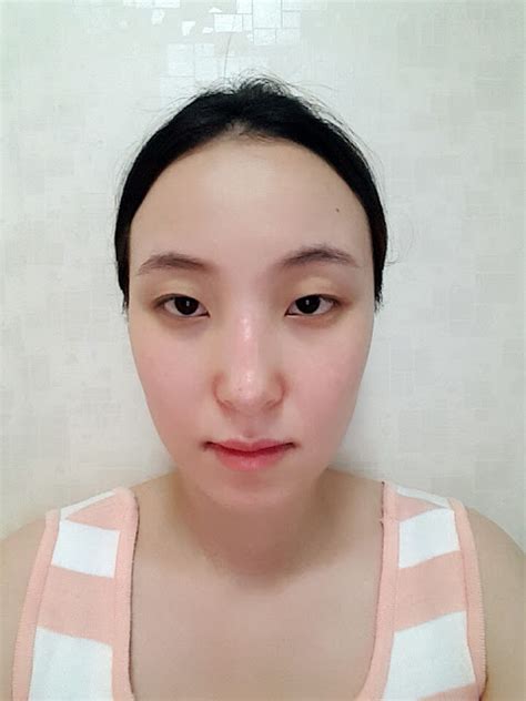 Real Patient Selfie: Aquiline Nose Surgery