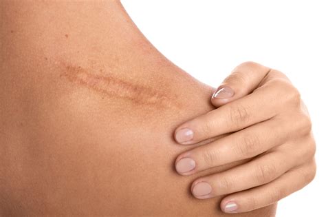 Proper Wound Care Can Prevent Scarring | Genesis Dermatology