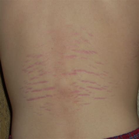 Bartonella Rash vs striae | Avenir