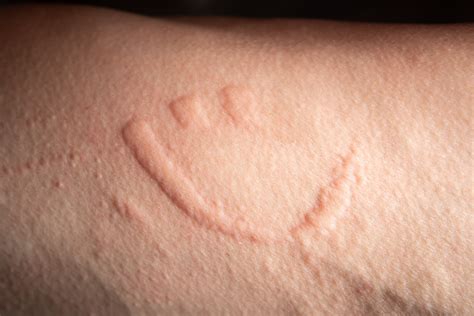 Dermatographia, Causes, Risk Factors and 7 Potential Treatments - Suzy ...