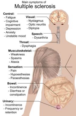 Signs and symptoms of multiple sclerosis - Wikipedia