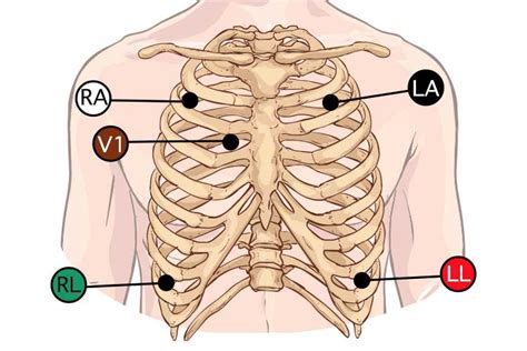 5-Lead ECG Placement and Cardiac Monitoring | Ausmed