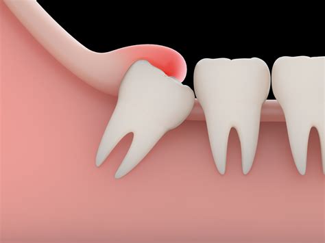 Minor Oral Surgery – Pure Dental Practice