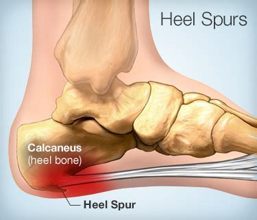 Heel Spurs: Symptoms, Causes, And Treatment | EVA Orthotic Insoles Manufacturer | Ideastep