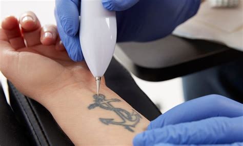 Saline Tattoo Removal vs Laser Tattoo Removal | Removery