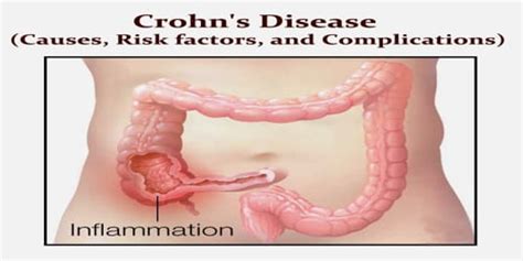 Crohn's Disease (Causes, Risk factors, and Complications) - Assignment ...