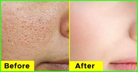 How To Minimize The Appearance Of Large Pores | Grandma's Things