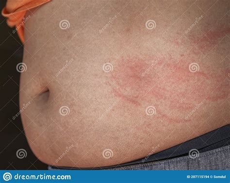 Itchy Skin Scratch Marks Stock Photos - Free & Royalty-Free Stock ...