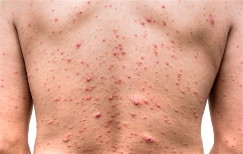 Hives vs Rash - What's the difference between them?