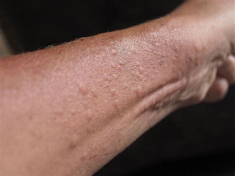 Common Childhood Skin Rashes With Pictures: What Rash Is This? - Which?