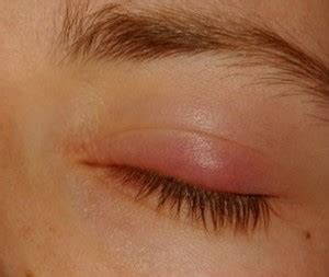 Eyelid Infection - Pictures, Causes, Treatment, Remedies