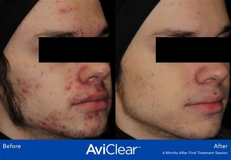 AviClear Before & After Photos | VITAHL Chicago