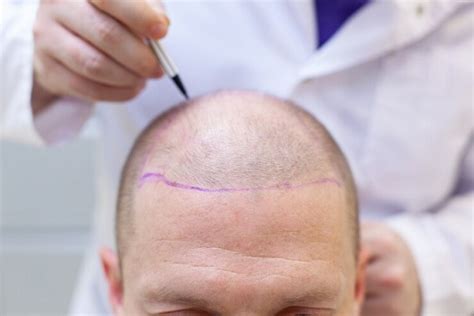 Identifying Candidates for Hair Transplants - CSS Philadelphia ️