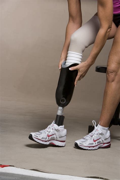 Artificial Leg Fitting | Orthotics and prosthetics, Below the knee amputation, Legs