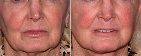 Skin Rejuvenation photos | Beverly Hills, CA. | Patient 16687