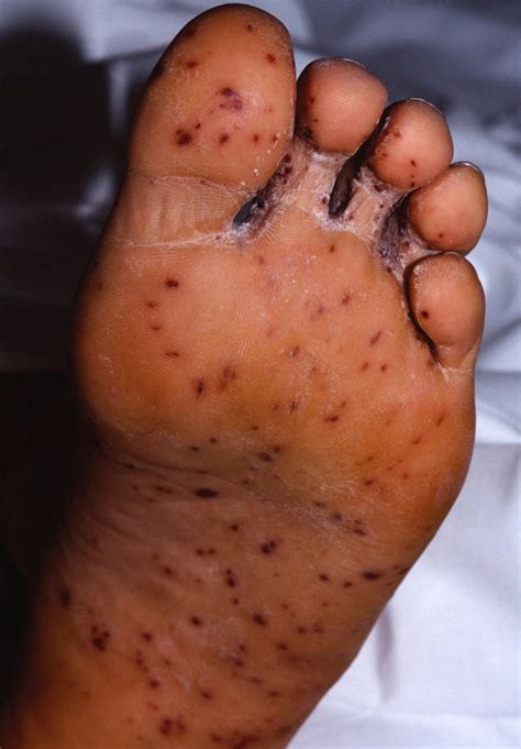 Measles - Causes, Rash, Symptoms, Signs, Measles Treatment