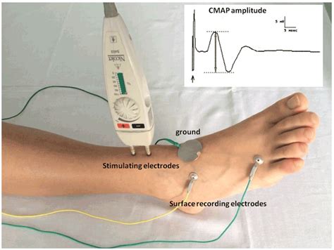 Pain after nerve conduction study - lasopaware