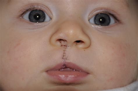 Cleft Lip And Palate Adult