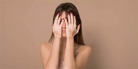 Leucoderma: Causes, Symptoms, and Treatments