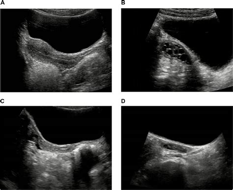 Frontiers | Pelvic Ultrasound in Diagnosing and Evaluating the Efficacy of Gonadotropin ...