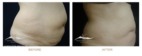 Before & After Vanquish – Newport Coast Dermatology