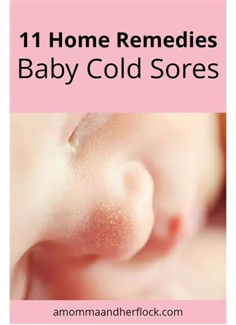 11 Home Remedies for Cold Sores in Babies and Toddlers | Cold sore, Cold home remedies, Cold ...