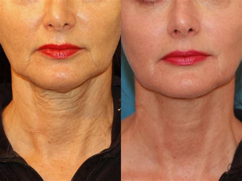 Sculptra® Aesthetic in Atlanta | Buckhead Facial Plastic Surgery