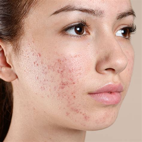 Acne and Acne Scarring Treatments | Face Teeth Smile | Gerrards Cross
