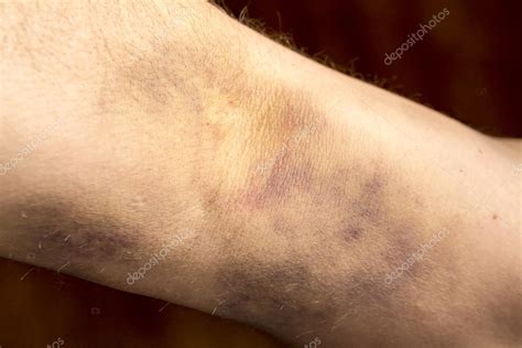 Grande hematoma no braço humano fotos, imagens de © CatherineL-Prod ...