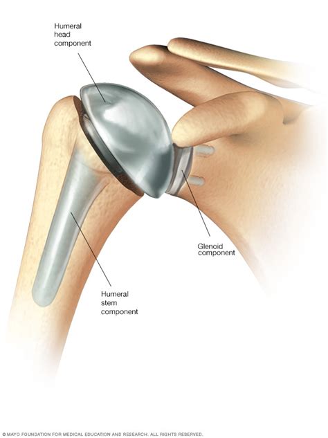 Shoulder replacement surgery | Beacon Health System