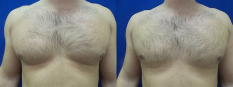 Gynecomastia Photos