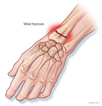 Wrist Injuries Treatment | Louisville & Lexington | Aptiva Health