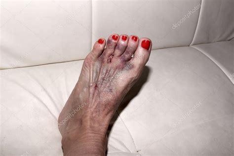 Foot after Mortons neuroma surgery Stock Photo by ©stephstarr9363@gmail.com 95003310