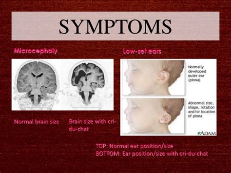 Cri du-chat syndrome