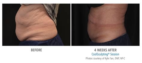 Is CoolSculpting® Right for Me? - Best Reflections