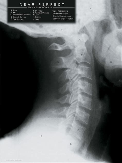 Normal Neck X-ray | Textbook Cervical Spine X-ray Poster