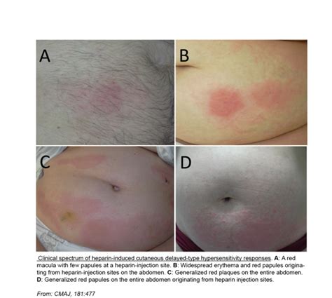 Heparin Subcutaneous Injection Sites