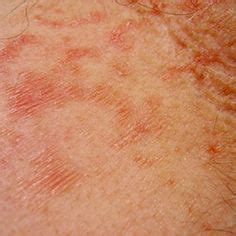 Rheumatoid arthritis rash how to identify – Artofit