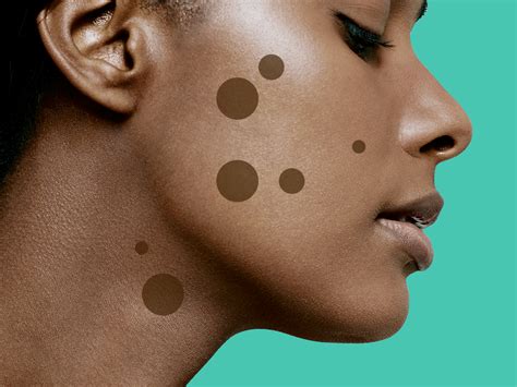 9 Dark Spot Treatments That Really Work, According to Dermatologists | SELF