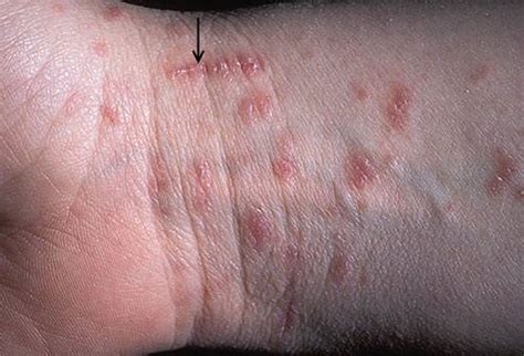 Scabies | Primary Care Dermatology Society | UK