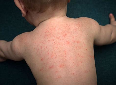 Baby Rashes: Types, Symptoms & More | Baby rash, Heat rash, Rashes