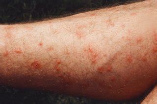 Insect bites and stings - Symptoms - NHS
