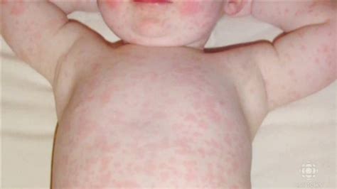 Measles Case in Metro Adelaide | Windsor Village Medical Centre