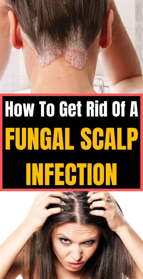 How To Get Rid Of A Fungal Scalp Infection | passionofswathi