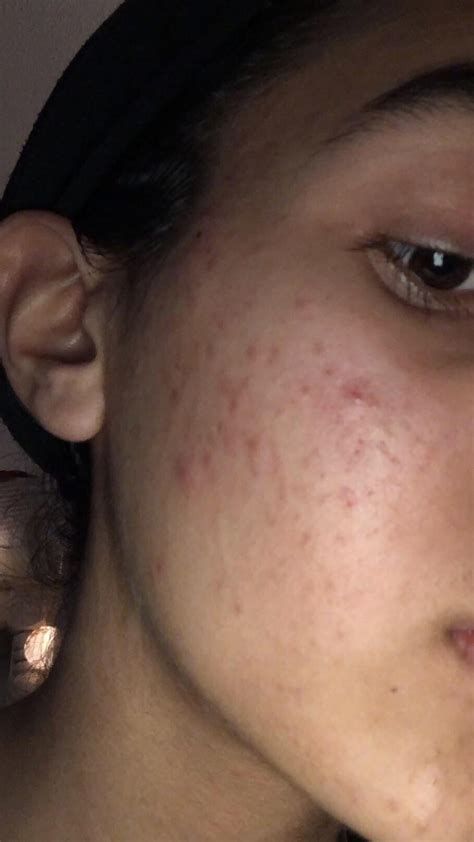 before + after accutane : r/acne