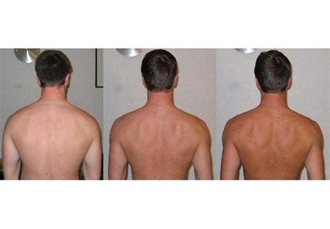 Before and after Melanotan tanning therapy, sunless tanning results