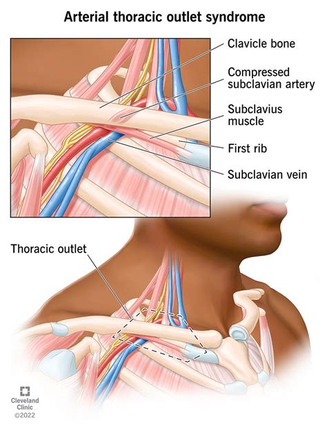 Arterial Thoracic Outlet Syndrome: Causes & Symptoms