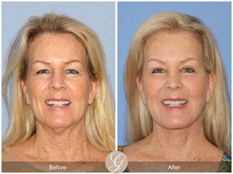 Neck Lift Before & After Photos From Dr. Kevin Sadati