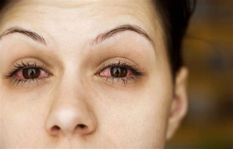 Burning Eyes: Causes, Symptoms, and Treatment